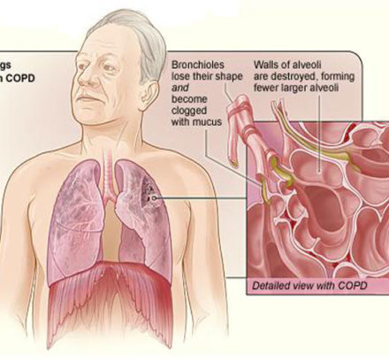 Copd_2010Side123