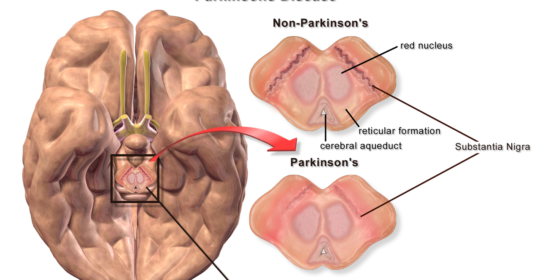 Parkinson’s disease: Production of dopamine neurons from stem cells steps closer
