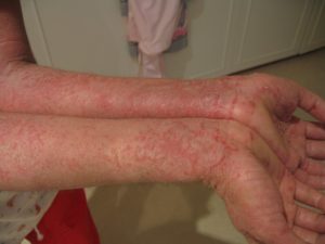 Eczema - Dermatology